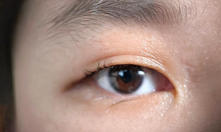 Double Eyelid